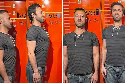 Student pays £36k to have his legs broken in surgery to become 3.7in taller