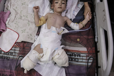 Gaza’s vulnerable suffer war’s toll: Malnourished, maimed and displaced