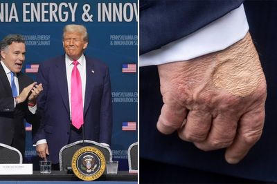 Trump’s strange bruised hand makes reappearance before president’s visit to Pittsburgh