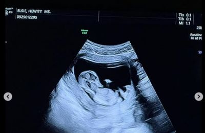 Pete Davidson and Elsie Hewitt expecting baby