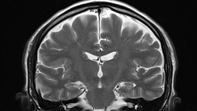 A single MRI can reveal how quickly you're aging, scientists claim
