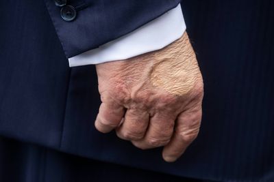 Trump Diagnosed With Vein Issue After Leg Swelling, Hand Bruising