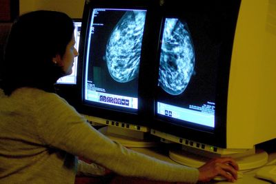 Breast cancer breakthrough as new test could revolutionise treatment