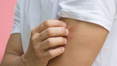 Mystery bites? How to identify what's really biting you (even if you see nothing)