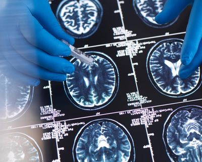 Optimists share similar brain patterns when thinking about the future, scans show