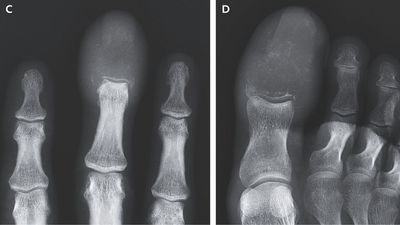 Weird swelling of man's fingers and toes revealed cancer had 'completely replaced' the bones with lesions