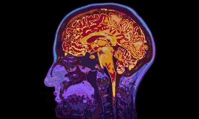 ‘Slip, slop, slap for brain health’: Australia needs a major prevention campaign for dementia, doctor says
