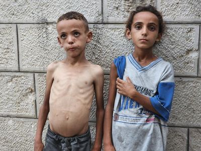 ‘We faced hunger before, but never like this’: skeletal children fill hospital wards as starvation grips Gaza