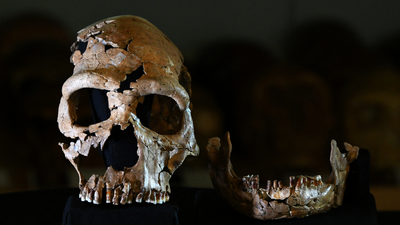 Neanderthal genes may explain disorder where brain bulges out of the skull