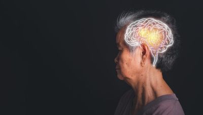 CervoMed's Dementia Data Show Slowed Disease Progression