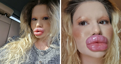 Woman With ‘World’s Biggest Lips’ Shares What She Looked Like Before $26K Extreme Surgeries