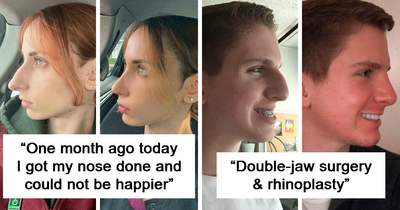 50 People Who Look Unrecognizable After Plastic Surgery