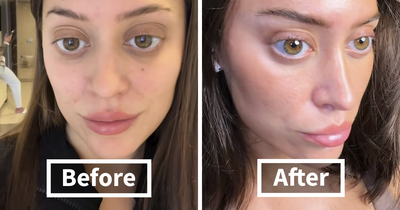 “I’m Honestly Terrified”: 28YO Gets A Facelift, People Are Questioning Reality