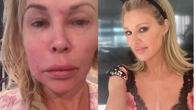 Real Housewives Star Brandi Glanville Suffers Painful Chemical Burns After Nair DIY Face Treatment Goes Wrong