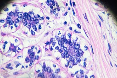 New study finds viral infections could re-awaken dormant cancer cells