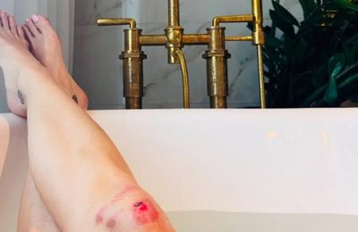 Katy Perry reveals bruises and scrapes sustained on her Lifetimes tour