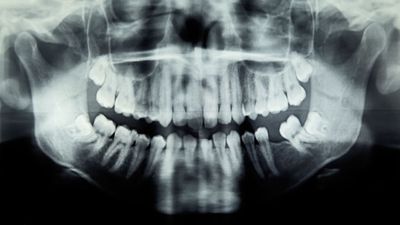 Diagnostic dilemma: Girl's dental trouble caused a life-threatening eye infection