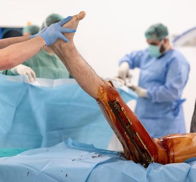 ‘Being short is a curse’: the men paying thousands to get their legs broken – and lengthened