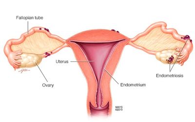 What Is Endometriosis? The Painful Symptoms, Period Struggles, Surgery Risks — And Bindi Irwin's Brave Reveal