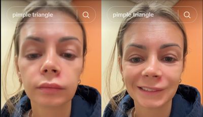 Woman Hospitalised After Popping a Pimple Most People Wouldn't Think Twice About — What Is the 'Triangle of Death'?