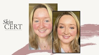 Rosacea Treatment, Symptoms and the Skincare to Rely on From the People in the Know