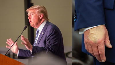 Donald Trump Swollen Hand Update: People's Growing Concerns, His Family's Silence, and POTUS Rage on MSNBC