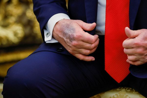 Trump reveals dark bruising on hand as he goes cover-up-free in Oval Office amid health concerns