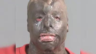 Badly disfigured South Carolina murder suspect turns himself in — says he’s innocent because of his injuries