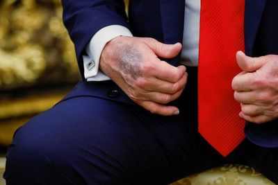 Newsom claps back at Trump’s ‘strange hand action’ remark after large bruising noted on president’s hands