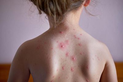 Vaccine for chickenpox to be rolled out on the NHS