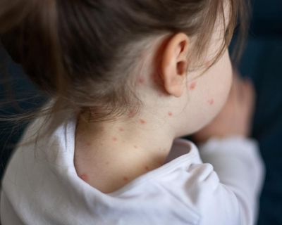 Why is chickenpox vaccination being offered to children in England next year?