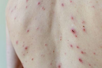 Minister urges take-up of chickenpox jab to defeat vaccine conspiracy theorists