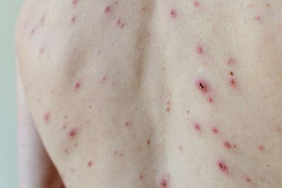 Get your children the chickenpox jab to stop the anti-vaxxers, minister tells parents ahead of NHS rollout
