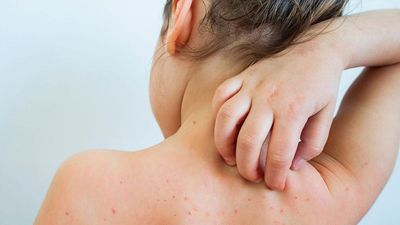 England to make chickenpox jab free for children for the first time