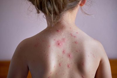 NHS Chickenpox vaccine: Everything you need to know