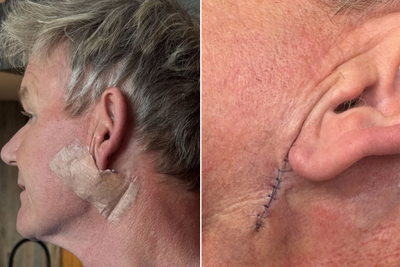 Gordon Ramsay reveals skin cancer scare after undergoing treatment to remove basal cell carcinoma