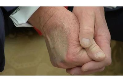 Donald Trump's Hand Has Bruises Again - Is It From A Sexually-Transmitted Disease Like Syphilis?
