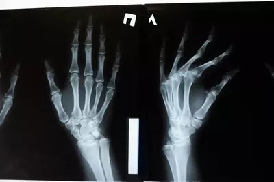 Why More Men Are Worrying About Bone Density