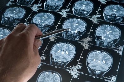 NHS given ‘key’ tool that could change stroke patients’ lives