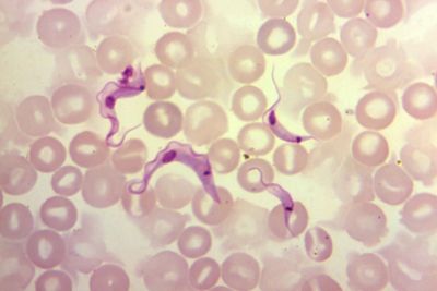Californians warned of invisible disease that can cause heart attacks and strokes