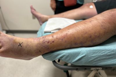 Florida father infected by bacteria that caused severe blisters on leg