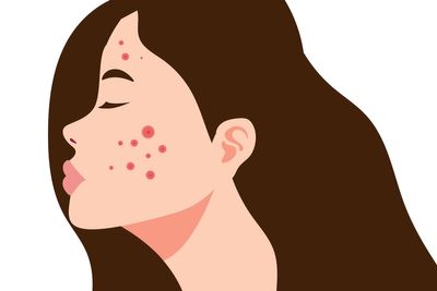 I’m 33 and adult acne has taken over my life. I know I’m not alone