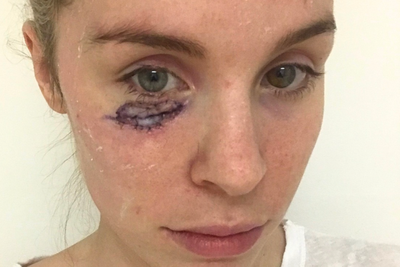 ‘I had a spot under my eye. It turned out to be cancer’