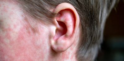 Child dies from complications of measles years after infection – SSPE explained