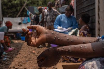 How Mpox revealed an epidemic of untreated HIV in Sierra Leone – as Trump’s aid cuts begin to bite