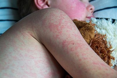 A child has died years after a measles infection. Here’s what we know