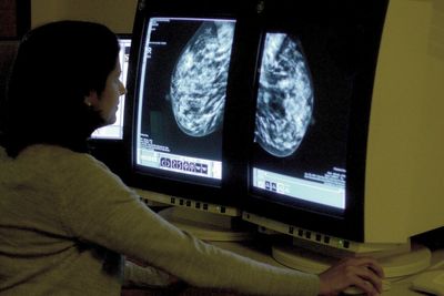AI could detect heart risk from breast screening images, study suggests