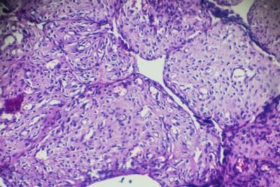 New blood test could detect cases of ovarian cancer sooner