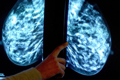 New technology could screen for both breast cancer and heart risks