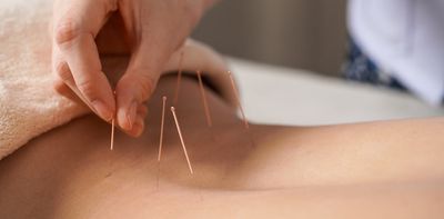 Is acupuncture worth it for back pain? New study has answers
